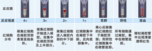 【試驗?zāi)康暮驮怼?    ABO血型鑒定是通過檢測被檢者紅細(xì)胞上是否存在A和/或B抗原（正定型）以及被檢者血漿中是否存在抗A和/或抗B抗體（反定型）來確定。  對于成年個體被檢者，紅細(xì)胞上的A和/或B抗原與血漿中的抗A和/或抗B抗體存在一種對應(yīng)關(guān)系。其獨特性質(zhì)在于：紅細(xì)胞上缺乏A和/或B抗原，則血清中存在與所缺乏的抗原對應(yīng)的強反應(yīng)性抗體，如紅細(xì)胞上缺乏A抗原，則可以預(yù)見血漿中存在抗A抗體。  常規(guī)的ABO定型必須包括正定型（紅細(xì)胞定型）和反定型（血漿定型），并將正反定型結(jié)果相互驗證，只有正反定型結(jié)果一致時才能準(zhǔn)確定型。  Rh陽性和Rh陰性的鑒定是通過檢測被檢者的紅細(xì)胞上是否有D抗原，有D抗原為Rh陽性，沒有D抗原則為Rh陰性。  ABO/RhD血型定型檢測試劑卡采用凝膠作為微柱凝膠卡的填充物，將生物化學(xué)的凝膠分子篩過濾技術(shù)、離心技術(shù)和血型血清學(xué)的抗體特異性結(jié)合在一起，其中 抗A凝膠管中灌注了含抗A抗體的凝膠，抗B凝膠管中灌注了含抗B抗體的凝膠，抗D凝膠管中灌注了含IgM抗D抗體的凝膠。A細(xì)胞、B細(xì)胞及Ctl管中灌注 了不含血型抗體的凝膠，抗A、抗B及抗D凝膠管用于紅細(xì)胞上A、B及D抗原檢測，而A細(xì)胞、B細(xì)胞用于檢測血漿中的抗體，Ctl管用于自身對照。當(dāng)抗原抗 體反應(yīng)時，凝集的紅細(xì)胞在離心力的作用下不能通過凝膠而留在凝膠上層或游離在凝膠中，呈現(xiàn)陽性反應(yīng)；而抗原抗體沒有反應(yīng)時，未凝集的紅細(xì)胞在離心力的作用 下可通過凝膠而沉積在微柱凝膠管的底部，呈現(xiàn)陰性反應(yīng)。  20121212104122758.jpg       【ABO/RhD血型定型檢測試劑卡的用途】  1.?用于輸血前檢測  (1) 鑒定ABO血型，以備選擇ABO血型相配合的血液用于交叉配血。  (2) 鑒定RhD血型，以備選擇RhD血型相配合的血液用于交叉配血。  2.?用于圍產(chǎn)期檢查  (1)?用于產(chǎn)前夫婦的ABO、RhD血型檢測，進(jìn)行新生兒溶血病產(chǎn)前預(yù)測。  (2)?用于產(chǎn)后母子的ABO、RhD血型檢測，進(jìn)行新生兒溶血病產(chǎn)后診斷。  3.?用于常規(guī)ABO、RhD血型化驗檢查，如健康體檢等。  【樣本要求】  1.?建議使用抗凝的血樣，尤其是EDTA抗凝管采集的血樣，需要量2ml 。（EDTA抗凝采血管為紫帽管）。  2.?血液樣本在采集后48小時以內(nèi)檢測。  【所需儀器設(shè)備及耗材】  1.?ABO、RhD血型定型檢測試劑卡  2.?血型血清學(xué)離心機（用于離心分離血漿、洗滌紅細(xì)胞）  3.?微柱凝膠卡離心機  4.?微量移液槍及吸頭  【試驗操作】?  按照下列步驟進(jìn)行操作  一、被檢血液樣本的處理及反定型A型、B型紅細(xì)胞的準(zhǔn)備  1.?EDTA抗凝的血液樣本離心3000rpm 1分鐘，將上清血漿轉(zhuǎn)入一支12×75mm 試管中，余下的壓積紅細(xì)胞備用。如果血漿有不溶物（如混入的紅細(xì)胞）或不澄清透明，則需要將血漿再次離心，直到澄清透明不含不溶物為止。  2.?另取一支12×75mm試管中，加入0.1ml上述步驟1中的壓積紅細(xì)胞 ，用生理鹽水洗滌一次，棄上清，得到壓積紅細(xì)胞。  3.?在一支12×75mm試管中，加入1ml生理鹽水（或LISS液），加入步驟2中得到的壓積紅細(xì)胞10μl，混勻得到0.8~1%的被檢紅細(xì)胞懸液。  4.?將反定型A型、B型紅細(xì)胞用生理鹽水或LISS液配制成0.8~1%濃度。  二、ABO、RhD定型  1.?取ABO/RhD血型定型檢測試劑卡一片，注意檢查外觀，確保凝膠管的凝膠上層存在液面，凝膠不會干涸。將符合要求的卡進(jìn)行標(biāo)記，按照試驗需要撕開封口膜。  2.?用微量移液槍分別向抗A、抗B、抗D孔及Ctl孔的每孔樣品槽中沿樣品槽內(nèi)壁呈45°角緩慢加入50μl 0.8~1%濃度的被檢者紅細(xì)胞懸液。  3.?向A細(xì)胞孔中加入50μl?0.8~1%的A型紅細(xì)胞懸液。  4.?向B細(xì)胞孔中加入50μl?0.8~1%的B型紅細(xì)胞懸液。  5.?分別向A細(xì)胞、B細(xì)胞、Ctl孔中加入25μl 被檢者血漿。  6.?在臺面交替輕扣卡左下角和右下角，確保所加入的液體在卡的樣品槽中呈水平狀態(tài)，而不是偏向一側(cè)。  7.?將卡放入微柱凝膠卡離心機離心，LB-3000低速離心機第一檔離心900rpm 2分鐘，再1500rpm 3分鐘，判讀結(jié)果并記錄。  【結(jié)果判讀及解釋】  1.?反應(yīng)陰、陽性的判讀  20121212104153407.jpg  【注意事項】  1. 建議在使用凝膠卡前先離心再應(yīng)用。  2. 若凝膠卡封口開裂、孔中凝膠干涸或有氣泡，不可使用。  3. 撕開凝膠卡封口膜時，不能用力過猛，以免造成凝膠微孔間的交叉污染。  4. 樣本采集后應(yīng)盡快檢測，若試驗需要延遲，應(yīng)將樣本置2~8℃下短期儲存。  5. 紅細(xì)胞懸液的濃度為0.8~1%，濃度過高或過低會影響檢測結(jié)果。  6. 溶血、脂血、細(xì)菌污染等情況的標(biāo)本會影響檢測結(jié)果。  7. 血漿或血清標(biāo)本須充分離心去除纖維蛋白，否則會阻止紅細(xì)胞在微柱凝膠中的沉降，出現(xiàn)假陽性。  8. 人源血液樣本存在潛在的傳染性，凝膠卡使用后按醫(yī)療生物垃圾處理。  9. 在Ctl孔（自身陰性對照）結(jié)果為陽性時，試驗結(jié)果無效?？赡茉蚴怯捎诒粰z紅細(xì)胞已經(jīng)致敏IgM抗體導(dǎo)致自發(fā)凝集，此時可以用DTT將已經(jīng)致敏到紅細(xì)胞上的IgM抗體破壞后再行 ABO、RhD血型檢測。  10. 抗D凝膠不能鑒定弱D、部分D（如DⅥ）抗原。對于患者，如果抗D凝膠管中患者的紅細(xì)胞反應(yīng)為陰性，則確定為RhD陰性。  11. 若出現(xiàn)＜2+的弱陽性反應(yīng)，須做進(jìn)一步試驗才能準(zhǔn)確定型，即確認(rèn)弱反應(yīng)是由于被檢者的抗原減弱還是凝膠微孔之間的交叉污染引起。  12. 若出現(xiàn)混合視野反應(yīng)，需要了解被檢者近期3個月內(nèi)是否有輸血史，或被檢者是否為骨髓移植患者。  13. 由于6月齡以下的嬰兒其血漿/血清中不似成人一樣存在可預(yù)見的抗A/抗B抗體，因此只做正定型不做反定型。  【ABO正反定型不一致原因分析】  如果血型定型正反定型結(jié)果不一致時，則不能準(zhǔn)確定型，需要分析產(chǎn)生不一致的原因。 引起正反定型不一致的原因如下：  （一）正定型出現(xiàn)弱反應(yīng)或缺失抗原  1. A亞型、B亞型或AB亞型。  2. 白血病導(dǎo)致A或B抗原減弱。  3. 何杰金?。℉odgkin’s）有時會抑制抗原表達(dá)，與白血病類似。  4. 由于某種疾病（如腹腔癌、胰腺癌）導(dǎo)致血漿中存在大量的血型物質(zhì)，中和抗A或抗B抗體，引起正定型為假陰性或弱陽性。 需要將正定型的紅細(xì)胞用生理鹽水洗滌后再次定型可解決此問題。  5. 骨髓移植。  6. 非ABO同型輸血。  （二）正定型紅細(xì)胞上多余的抗原反應(yīng)  1. 自身凝集紅細(xì)胞、抗體致敏紅細(xì)胞導(dǎo)致。  2. 細(xì)胞未洗滌，血漿蛋白引起的假陽性反應(yīng)。  3. 細(xì)胞未洗滌，血漿中存在針對正定型試劑中某種成分的抗體導(dǎo)致。  4. 骨髓移植。  5. 獲得性B。     6. B（A）現(xiàn)象。?  7. ABO非相合輸注。?  （三）正定型出現(xiàn)混合視野反應(yīng)?  1. 近期輸血。?  2. 骨髓移植。?  3. 異卵雙胞胎或雙受精卵產(chǎn)生的嵌合體。?  4. 胎兒和母體出血。?  （四）反定型血清中出現(xiàn)弱反應(yīng)或反應(yīng)缺失?  1. 年齡相關(guān)：新生兒以及小于6月齡的嬰兒以及老年人。?  2. ABO亞型有亞型抗體，如A2、A2B型人的抗A1。?  3. 低球蛋白血癥（如白血病人、使用免疫抑制劑患者、免疫缺陷患者）。?  4. 移植患者使用抗排異藥物。?  5. 雙胞胎或雙受精卵產(chǎn)生的嵌合體。?  （五）反定型出現(xiàn)多余的抗體反應(yīng)?  1. 冷自身抗體。?  2. 特異性冷同種抗體A。?  3. 血清中存在針對試劑紅細(xì)胞保存液成分的抗體。?  4. 某些疾病導(dǎo)致球蛋白水平增高（多發(fā)性骨髓瘤、巨球蛋白血癥、Hodgkin’s　淋巴瘤）引起緡錢狀凝集。　  5. 輸用大分子血漿擴容劑。?  6. 非ABO同型的移植。?  7. 靜脈注射免疫球蛋白。?  （六）技術(shù)方面的錯誤?  1. 血液樣本被污染，如混入其他人樣本。?  2. 被檢紅細(xì)胞的濃度過高或過低。?  3. 忘記在反應(yīng)體系中加入檢測樣本或試劑。?  4. 未按照試劑使用說明進(jìn)行試驗。?  5. 離心步驟離心時間不足或離心時間超時。?  6. 對試驗結(jié)果記錄或判讀不正確。